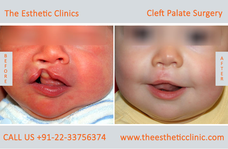 cleft palate surgery, Cleft Palate Repair Treatment before after photos in mumbai india (1)